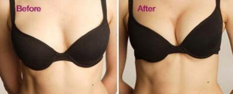 假體豐胸的副作用有哪些？假體豐胸*嗎？