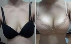 上海假體豐胸費(fèi)用、上海假體豐胸手術(shù)多少錢？