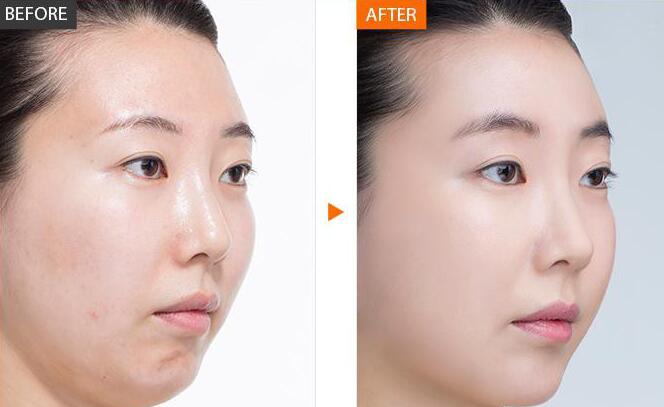 光子嫩膚*果能維持多久、全身光子嫩膚多少錢？