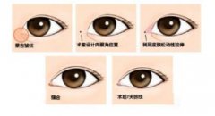 韓式開(kāi)眼角手術(shù)果怎么樣？開(kāi)眼角前后照