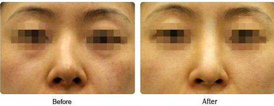 歪鼻矯正風(fēng)險大嗎、歪鼻矯正手術(shù)多少錢