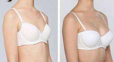 內(nèi)窺鏡隆胸到底痛不痛？?jī)?nèi)窺鏡隆胸多少錢？