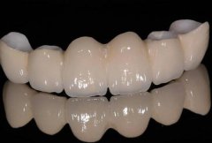 種植烤瓷牙的價(jià)格？種植烤瓷牙大概多少錢(qián)？