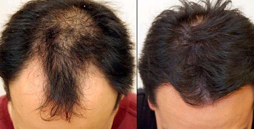 調節(jié)脫發(fā)多少費用？上海調節(jié)脫發(fā)要多少錢？