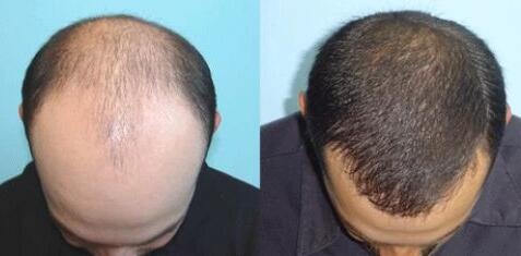 調節(jié)脫發(fā)多少費用？上海調節(jié)脫發(fā)要多少錢？