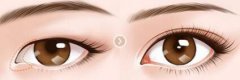 做開(kāi)眼角大概多少錢(qián)？做開(kāi)眼角的價(jià)格