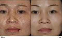 治雀斑多少錢(qián)？治雀斑價(jià)格是多少？