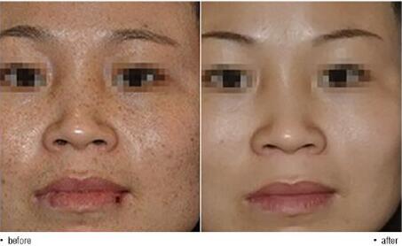 治雀斑,多少錢,價格