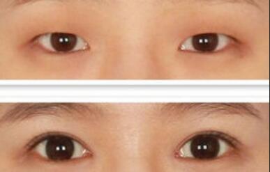 做開(kāi)眼角價(jià)格、開(kāi)眼角費(fèi)用詳細(xì)解析