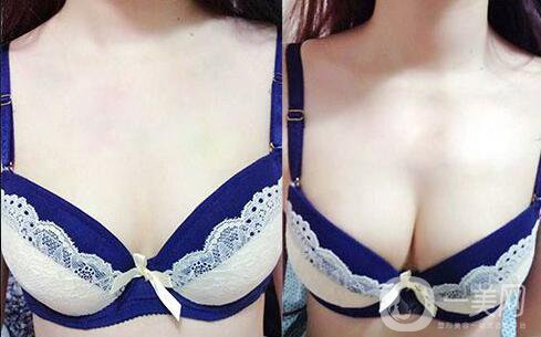 湛江做假體豐胸怎么樣？假體豐胸的*果好嗎？