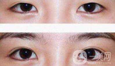 割雙眼皮多少錢(qián)？雙眼皮手術(shù)費(fèi)用詳細(xì)解答
