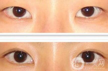 割雙眼皮多少錢(qián)？雙眼皮手術(shù)費(fèi)用詳細(xì)解答