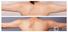 手臂吸脂術(shù)*嗎？手臂吸脂有危險嗎？