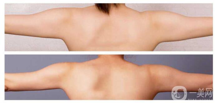 手臂吸脂術(shù)*嗎？手臂吸脂有危險嗎？