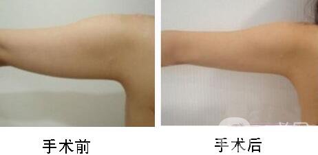 手臂吸脂術(shù)*嗎？手臂吸脂有危險嗎？