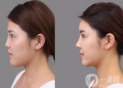 膨體隆鼻能維持多久？膨體隆鼻能保持終生嗎？