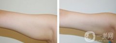 手臂吸脂術(shù)后怎么護(hù)理？術(shù)后注意事項有哪些？