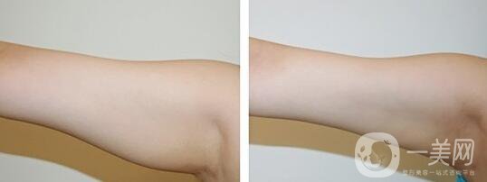 手臂吸脂術(shù)后怎么護(hù)理？術(shù)后注意事項有哪些？