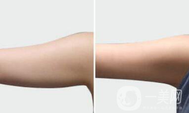 手臂吸脂術(shù)后怎么護(hù)理？術(shù)后注意事項有哪些？