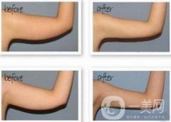 手臂吸脂風(fēng)險有哪些？手臂吸脂有副作用嗎？