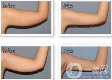 手臂吸脂風(fēng)險有哪些？手臂吸脂有副作用嗎？