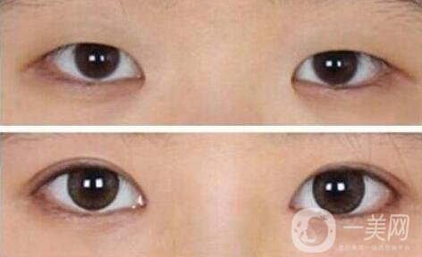 開眼角需要多少錢？開眼角和不開的區(qū)別圖