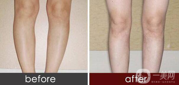 北京華意李沁奕做O型腿矯正怎么樣