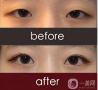 改臉型手術(shù)多少錢？改臉型手術(shù)有危險嗎？