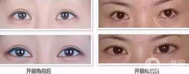 雙眼皮開眼角價格是多少？割雙眼皮開眼角多少錢？