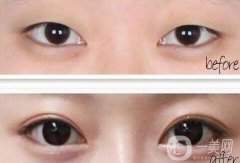雙眼皮開(kāi)眼角價(jià)格是多少？割雙眼皮開(kāi)眼角多少錢(qián)？