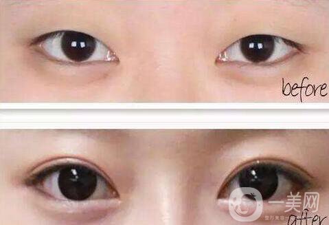 雙眼皮開眼角價格是多少？割雙眼皮開眼角多少錢？