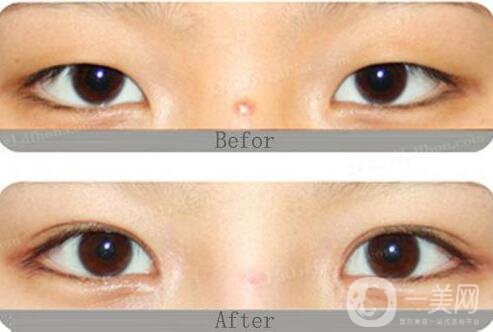 開眼角割雙眼皮價(jià)格、開眼角割雙眼皮多少錢？