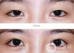 成都割雙眼皮哪里專業(yè)？割雙眼皮介紹？