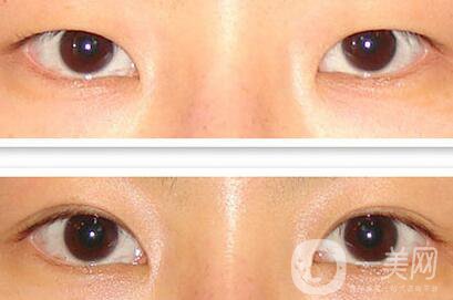 成都割雙眼皮哪里專業(yè)？割雙眼皮介紹？