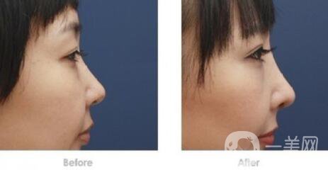 深圳做硅膠隆鼻多少錢？硅膠隆鼻費(fèi)用詳細(xì)解析