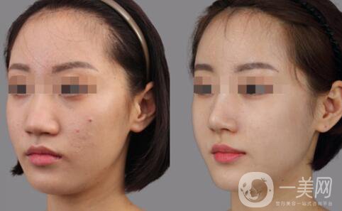 深圳做硅膠隆鼻多少錢？硅膠隆鼻費(fèi)用詳細(xì)解析