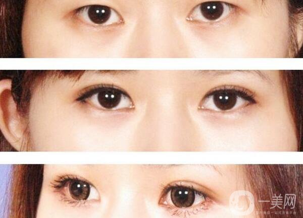 割雙眼皮要花多少錢？割雙眼皮手術價格詳細解析