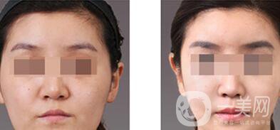 上海自體脂肪豐眉弓價(jià)格、自體脂肪豐眉弓多少錢