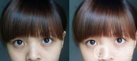 黑眼圈可以打玻尿酸嗎？玻尿酸去黑眼圈*果如何？