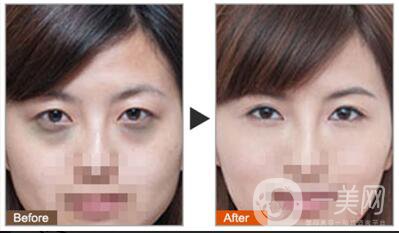 黑眼圈可以打玻尿酸嗎？玻尿酸去黑眼圈*果如何？