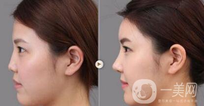 上海假體隆鼻多少費用？假體隆鼻價格詳細分析