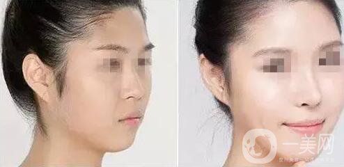 上海假體隆鼻多少費用？假體隆鼻價格詳細分析