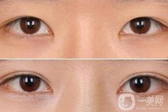 割雙眼皮后注意什么？術(shù)后注意事項盤點~