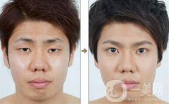 男士割雙眼皮果怎樣？有哪些方式？