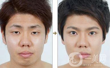 男士割雙眼皮*果怎樣