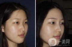 廣東硅膠隆鼻需要多少錢呢？廣東硅膠隆鼻價格？