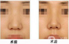 上海膨體隆鼻多少費用？上海膨體隆鼻多少錢？