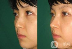 廣東膨體隆鼻整形多少錢？廣東膨體隆鼻費用？