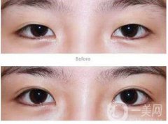 割雙眼皮要多久恢復？割雙眼皮恢復時間？