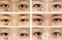 開眼角大概多少錢？開眼角價格一般是多少？